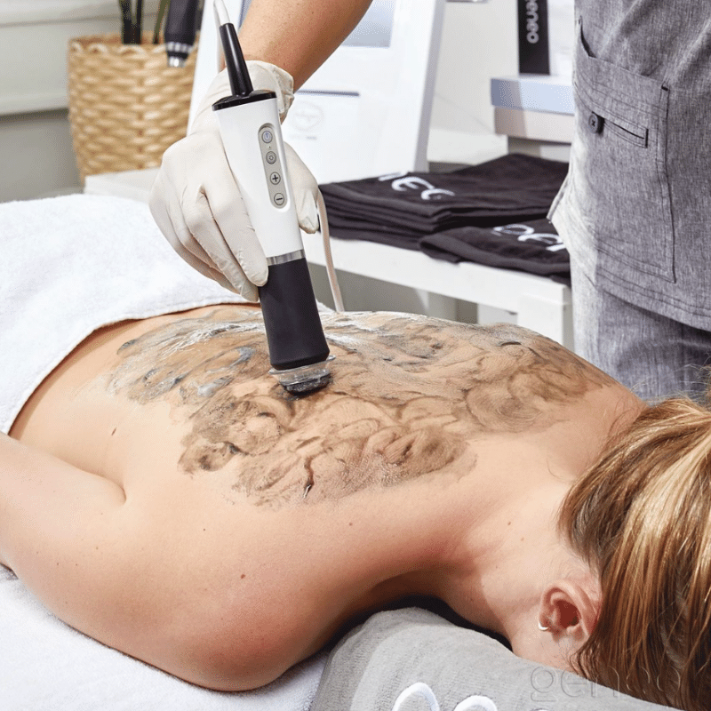 Woman receiving a Geneo facial treatment on her back. The oxypod leaves a dark-colored residue as the esthetician performs the treatment.