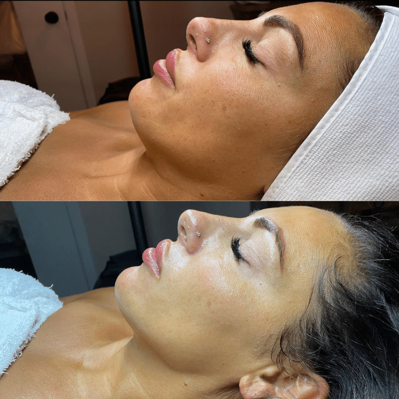 Two images demonstrating a woman's face both before and after a Geneo facial 